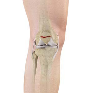 Recurrent Patella Dislocation