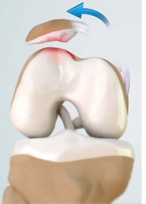 Chondral (Articular Cartilage Defects)