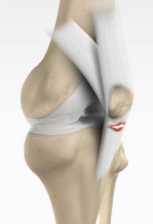 Lateral Meniscus Syndrome